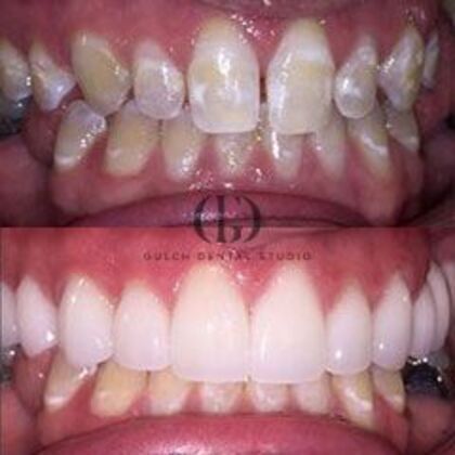 Smile Makeover Case 57