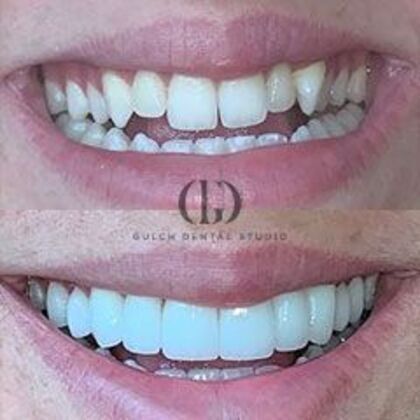 Smile Makeover Case 58