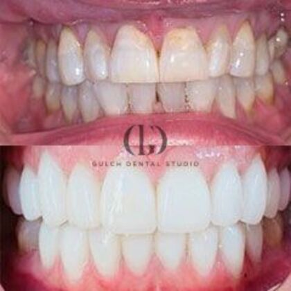 Smile Makeover: Case 59