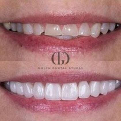 Smile Makeover Case 60