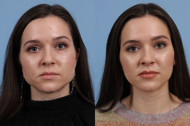 Facial Reshaping