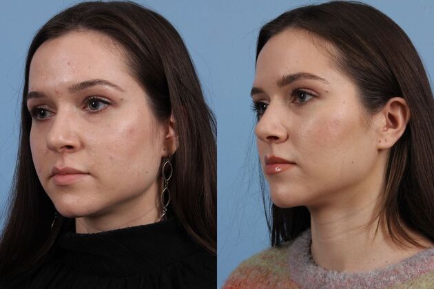 Facial Reshaping