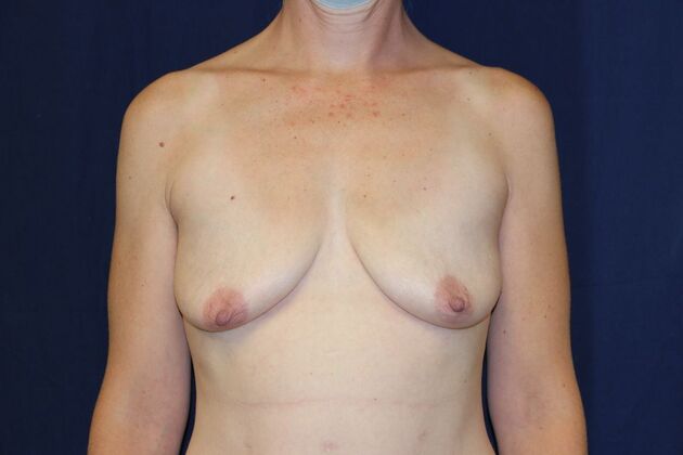 Breast Lift With Augmentation* Case 22 - Before