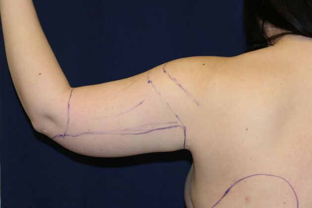 Arm Lift*/Arm Sculpting: Case 17 - Before