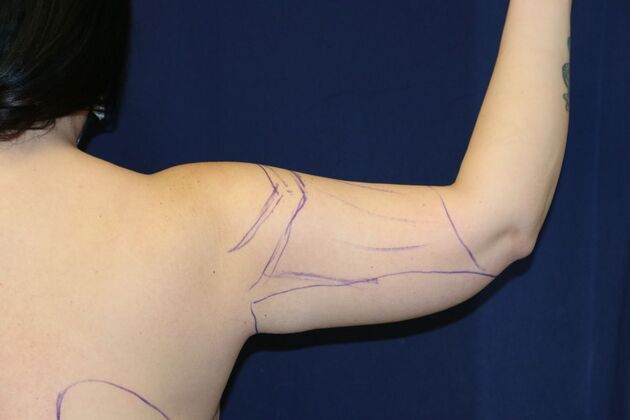 Arm Lift*/Arm Sculpting: Case 17 - Before