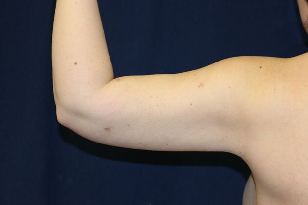 Arm Lift*/Arm Sculpting: Case 17 - After