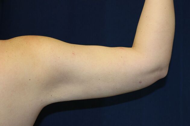 Arm Lift*/Arm Sculpting: Case 17 - After