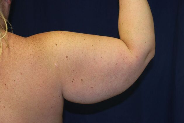 Arm Lift*/Arm Sculpting: Case 16 - Before