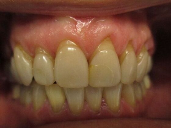 Dental Crowns: Dental Crowns - 8 Upper - Before