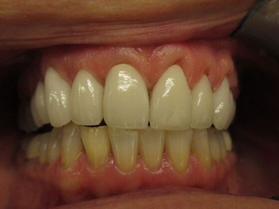 Dental Crowns: Dental Crowns - 8 Upper - After