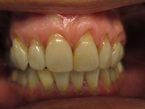 Full Mouth Reconstruction Crowns - 8 Upper - Before