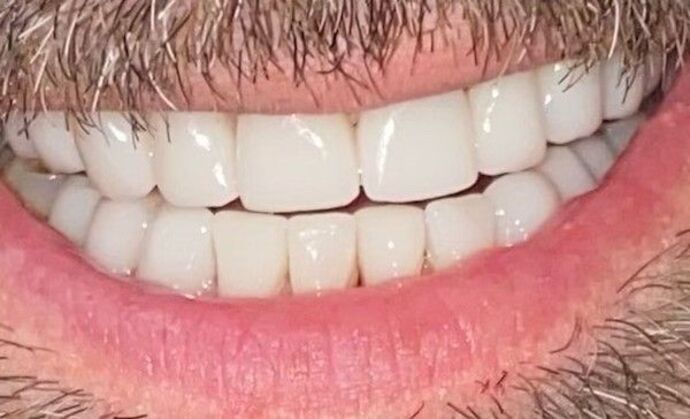 Veneers Case 2 - After