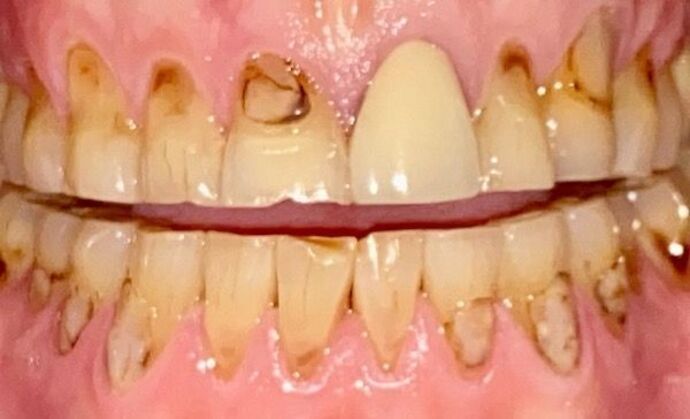 Veneers Case 2 - Before