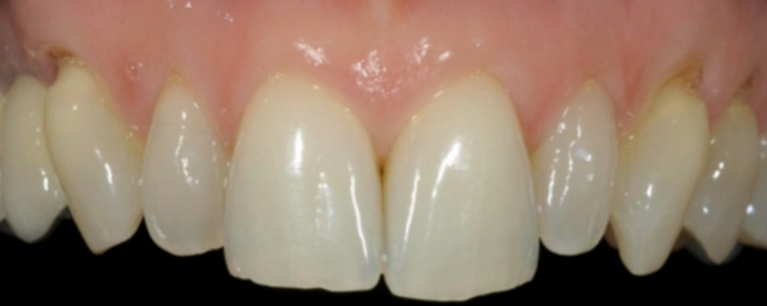 Porcelain Veneers Case 2 - Before