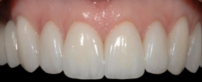 Porcelain Veneers Case 2 - After