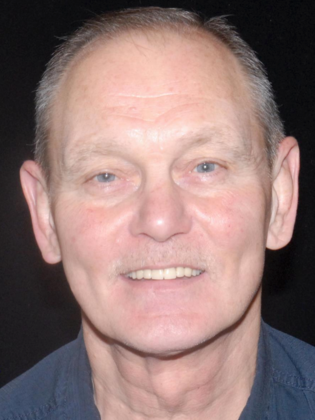 All-on-4 Case 1 - Before