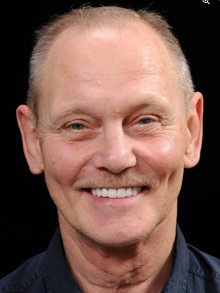 All-on-4 Case 1 - After