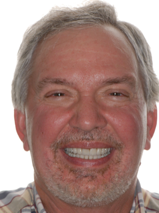 Crowns Case 1 - After