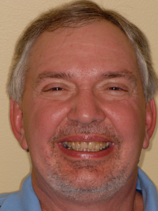 Crowns Case 1 - Before