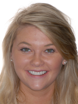 Crowns Case 2 - After