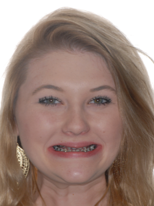 Crowns Case 2 - Before