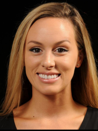 Gum Contouring Case 1 - After