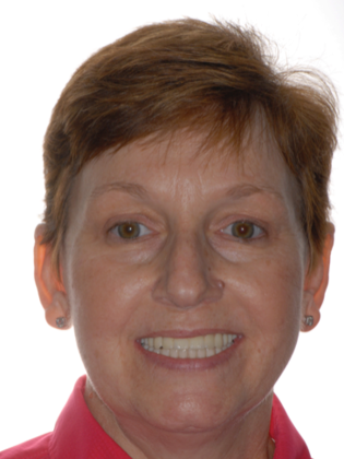 Full Mouth Reconstruction Case 1 - After