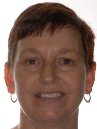 Full Mouth Reconstruction Case 1 - Before