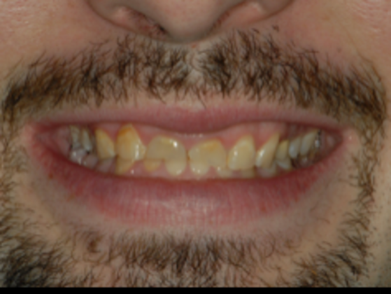 Full Mouth Reconstruction Case 2 - Before