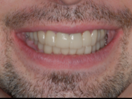 Full Mouth Reconstruction Case 2 - After