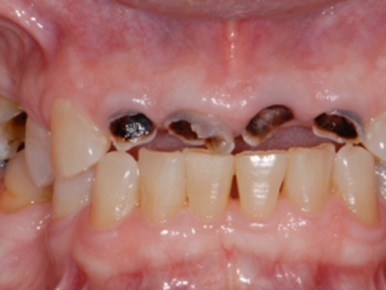 Full Mouth Reconstruction Case 3 - Before