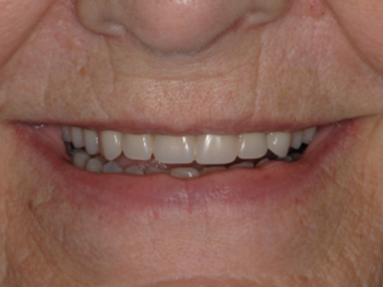 Full Mouth Reconstruction Case 3 - After