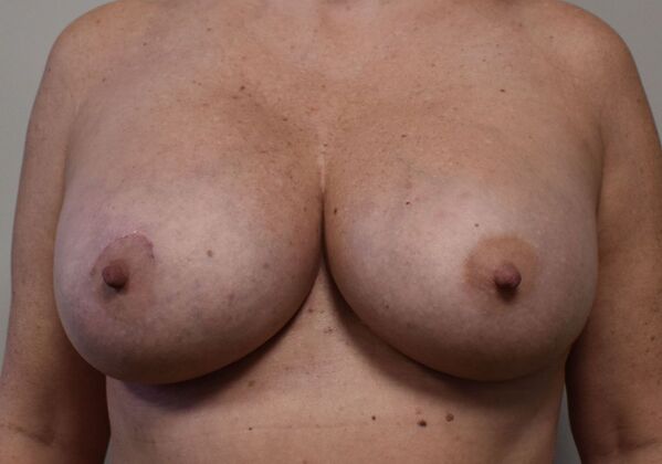 Breast Augmentation Case 712 - After