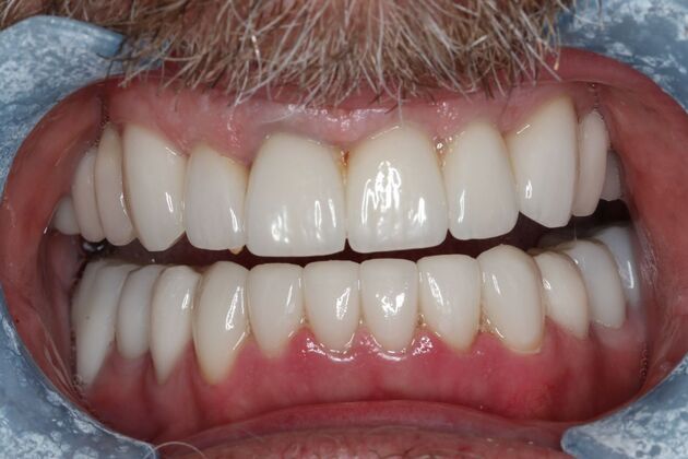 Dental Crowns: Case 29 - After