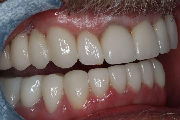 Dental Crowns: Case 29 - After Upper & Lower