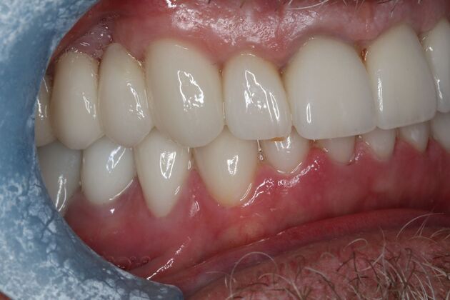 Dental Crowns: Case 29 - After