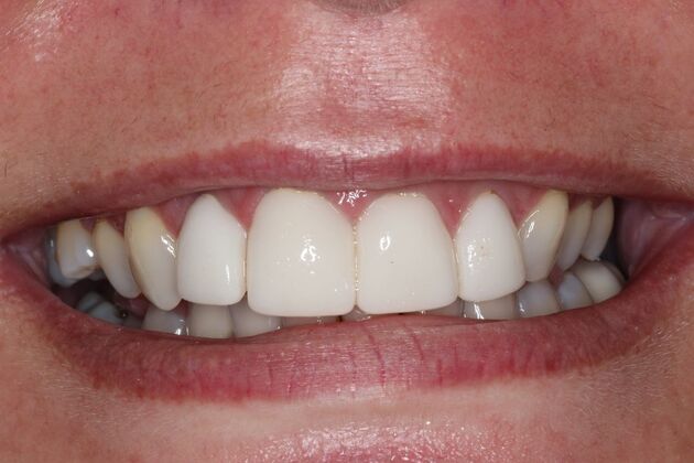Veneers Case 29 - Before