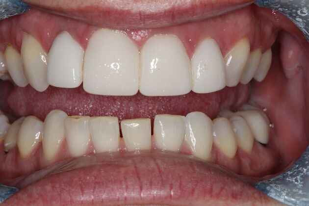 Veneers: Case 29 - Before