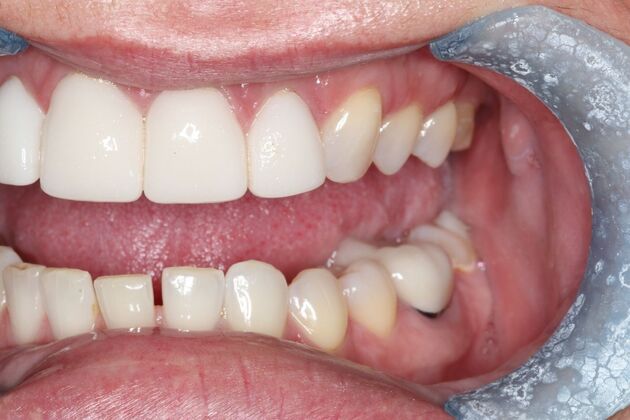 Veneers: Case 29 - Before