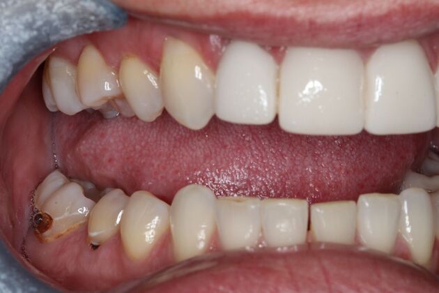 Veneers: Case 29 - Before