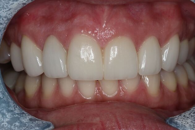 Veneers Case 29 - After