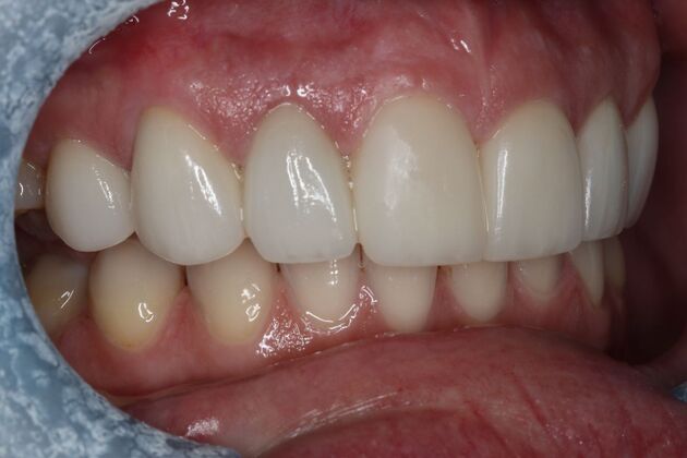 Veneers: Case 29 - After