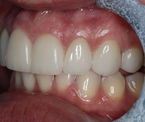Veneers: Case 29 - After