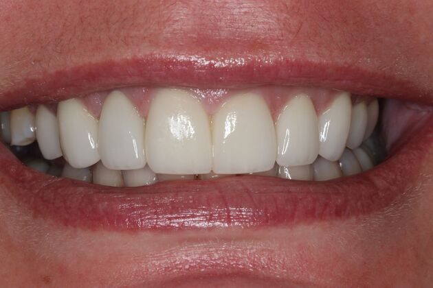 Veneers: Case 29 - After
