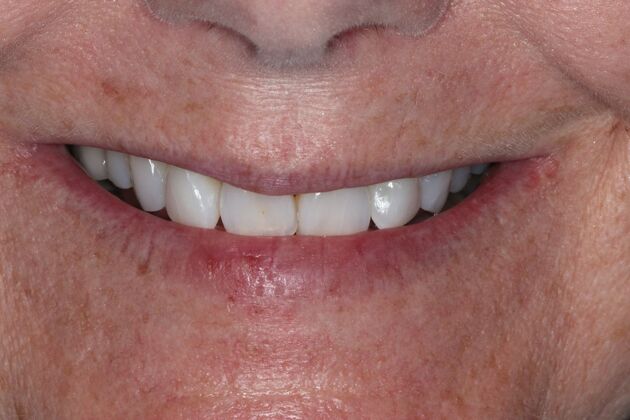 Teeth In A Day Case 27 - Before