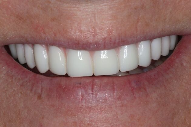 Teeth In A Day Case 27 - After