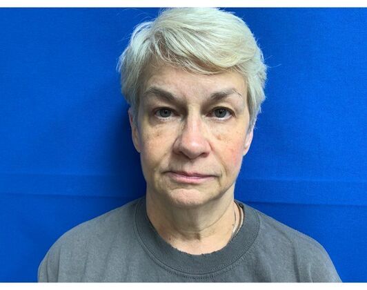 Facelift Case 16 - Before