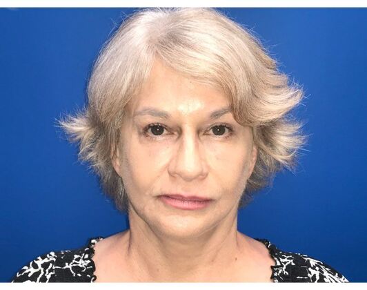 Facelift Case 16 - After