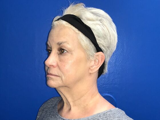 Facelift: Case 16 - Before