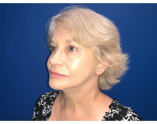 Facelift: Case 16 - After